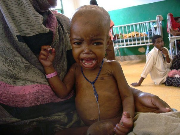 Un enfant somalien souffrant de malnutrition aigue